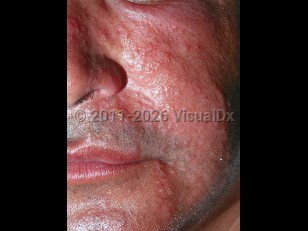 Clinical image of Sea cucumber skin irritation - imageId=3971683. Click to open in gallery.  caption: 'Widespread erythematous and edematous papules and plaques with some crusting on the face.'
