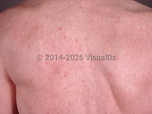 Transient acantholytic dermatosis