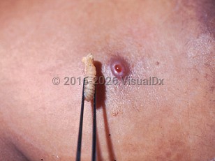 Clinical image of Myiasis - imageId=402355. Click to open in gallery.  caption: 'A close-up of a glistening pink and brown papule with a central cavity and the extracted larva of <i>Wohlfahrtia</i><i>&nbsp;vigil</i>.'