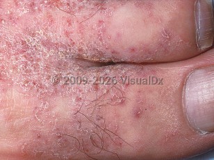 Crusted scabies