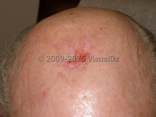 Clinical image of Erosive pustular dermatosis - imageId=4056502. Click to open in gallery.  caption: 'A crusted erosion with a surrounding faint pink scar on the central scalp. Note also the single pustule on the anterior scalp.'