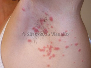 Clinical image of Guttate psoriasis - imageId=4158773. Click to open in gallery.  caption: 'Well-demarcated salmon-pink scaly papules, some confluent, in the axilla.'