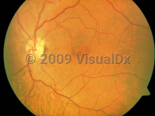 Ophthalmic Imaging image of Central retinal artery occlusion - imageId=4174771. Click to open in gallery. 