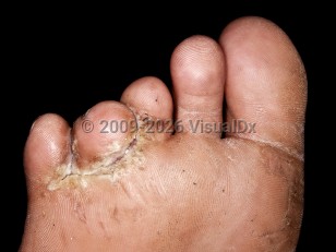 Mixed toe web infection