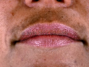 Clinical image of Melasma - imageId=425827. Click to open in gallery.  caption: 'An evenly pigmented tan patch on the upper cutaneous lip.'