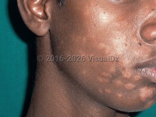 Post-kala-azar dermal leishmaniasis