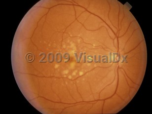 Ophthalmic Imaging image of Age-related macular degeneration - imageId=4378880. Click to open in gallery. 