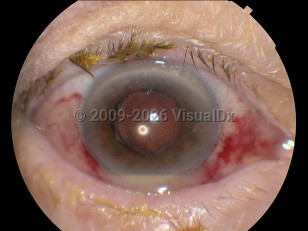 Endophthalmitis