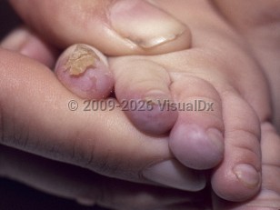 Clinical image of Richner-Hanhart syndrome - imageId=4404111. Click to open in gallery.  caption: 'Vesicles and bullae on the distal toes.'