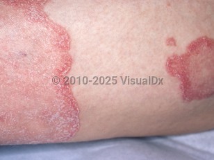 Pustular psoriasis