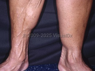 Clinical image of Lipoatrophy - imageId=4420916. Click to open in gallery.  caption: 'Loss of girth of the right leg, secondary to lipoatrophy.'