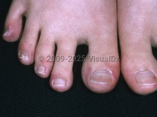 Clinical image of Cryofibrinogenemia - imageId=4477923. Click to open in gallery.  caption: 'Erythematous and purpuric papules and plaques on the distal toes of a patient with lupus.'