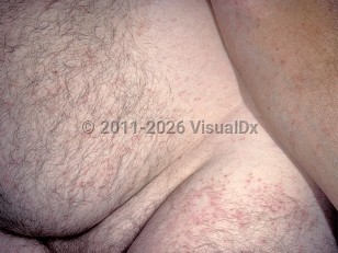 Ehrlichiosis