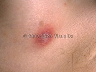 Ecthyma gangrenosum