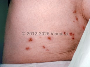 Mycoplasma exanthem