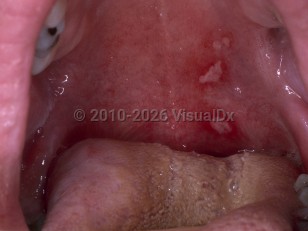 Herpangina