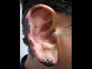 Clinical image of Cocaine levamisole toxicity - imageId=4802022. Click to open in gallery.  caption: 'Hemorrhagic crusting on the helical rim and earlobe.'
