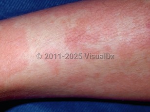 Clinical image of Serum sickness - imageId=4814. Click to open in gallery.  caption: 'Widespread thin erythematous papules and plaques on the leg.'