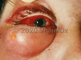 Preseptal cellulitis