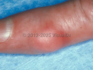 Clinical image of Gout - imageId=48739. Click to open in gallery.  caption: 'Erythematous nodule over the lateral distal interphalangeal joint.'