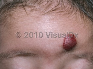 Clinical image of Infantile hemangioma - imageId=4896116. Click to open in gallery.  caption: 'A deep red nodule on the lower forehead.'