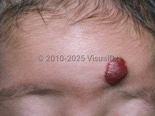 Clinical image of Infantile hemangioma - imageId=4896116. Click to open in gallery.  caption: 'A deep red nodule on the lower forehead.'