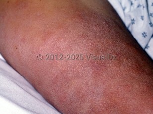 Clinical image of Leprosy - imageId=49440. Click to open in gallery.  caption: 'Numerous reddish-brown plaques and nodules on the arm.'