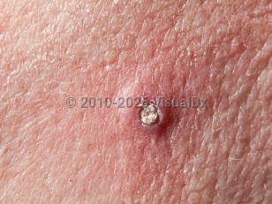 Clinical image of Pilar sheath acanthoma - imageId=4991352. Click to open in gallery.  caption: 'A close-up of a pink papule with keratotic material clogging a central pore.'