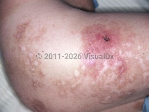 Leprosy-Lucio phenomenon