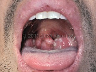Tonsillitis