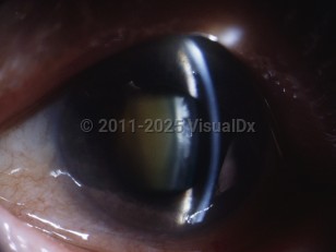 Ophthalmic Imaging image of Acute angle-closure glaucoma - imageId=5318399. Click to open in gallery. 