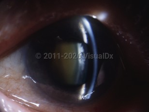 Ophthalmic Imaging image of Acute angle-closure glaucoma - imageId=5318399. Click to open in gallery. 