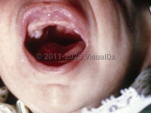 Clinical image of Pierre-Robin syndrome - imageId=5364008. Click to open in gallery.  caption: 'Mandibular hypoplasia.'