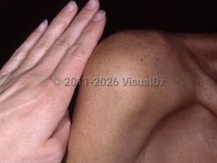 Hemochromatosis