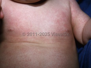Clinical image of Roseola - imageId=5509644. Click to open in gallery.  caption: 'Discrete and confluent reddish macules, papules, patches, and thin plaques on the arm and trunk.'