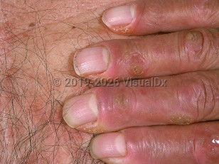 Clinical image of Acrokeratosis paraneoplastica - imageId=557055. Click to open in gallery.  caption: 'Hyperkeratotic papules and plaques involving the dorsal surface of the digits.'