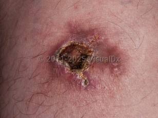 Clinical image of Epithelioid sarcoma - imageId=5615696. Click to open in gallery.  caption: 'A close-up of a violaceous, ulcerated and crusted plaque with an atrophic portion.'