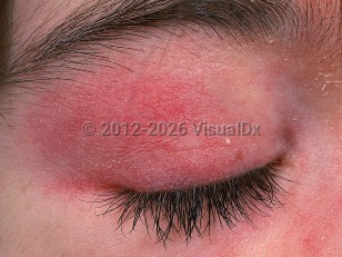 Dermatomyositis