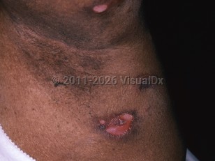 Lymphomatoid granulomatosis