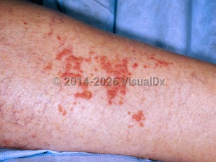Clinical image of Warty dyskeratoma - imageId=5926976. Click to open in gallery.  caption: 'A large cluster of many discrete and confluent reddish papules, each with overlying thick scale, on the forearm.'