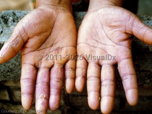 Trichinellosis