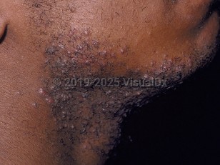 Clinical image of Pseudofolliculitis barbae - imageId=60574. Click to open in gallery.  caption: 'Perifollicular papules and pustules in the beard area.'