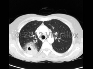 Imaging Studies image of Acinetobacter infection - imageId=6106611. Click to open in gallery.  caption: '<span>Acinetobacter community acquired pneumonia.</span>'