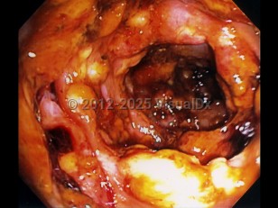 Clostridioides difficile colitis