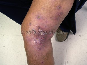 Mycobacterium fortuitum infection