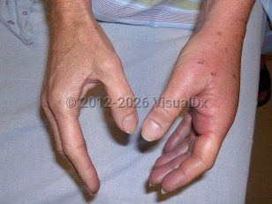 Clinical image of Animal bite infection - imageId=6112227. Click to open in gallery.  caption: '<span>Pasteurella multocida infection;</span>&nbsp;24 hours post cat bite.<br />'