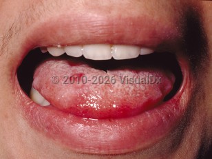 Clinical image of Behçet syndrome - imageId=61375. Click to open in gallery.  caption: 'An erosion and a small ulcer on the tongue.'