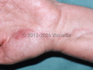 Clinical image of Lymphangitis - imageId=6150795. Click to open in gallery.  caption: 'Subtle deeply erythematous papules and surrounding erythema on the palm (HSV) and a curvilinear erythematous streak extending proximally from it (lymphangitis).'