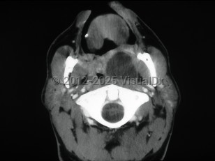 Peritonsillar abscess