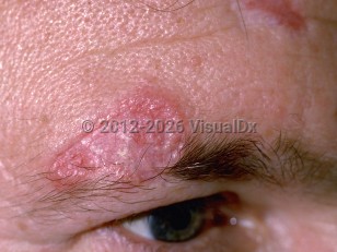 Clinical image of Discoid lupus erythematosus - imageId=61744. Click to open in gallery.  caption: 'An atrophic, scarred, pink plaque with raised borders on the lower forehead and eyebrow. Note the permanent loss of eyebrow hairs within the scarred area.'